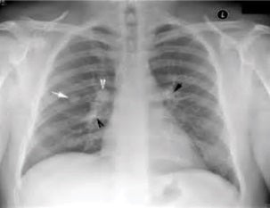 Pulmonary Nodules: What are They and Should You Worry?