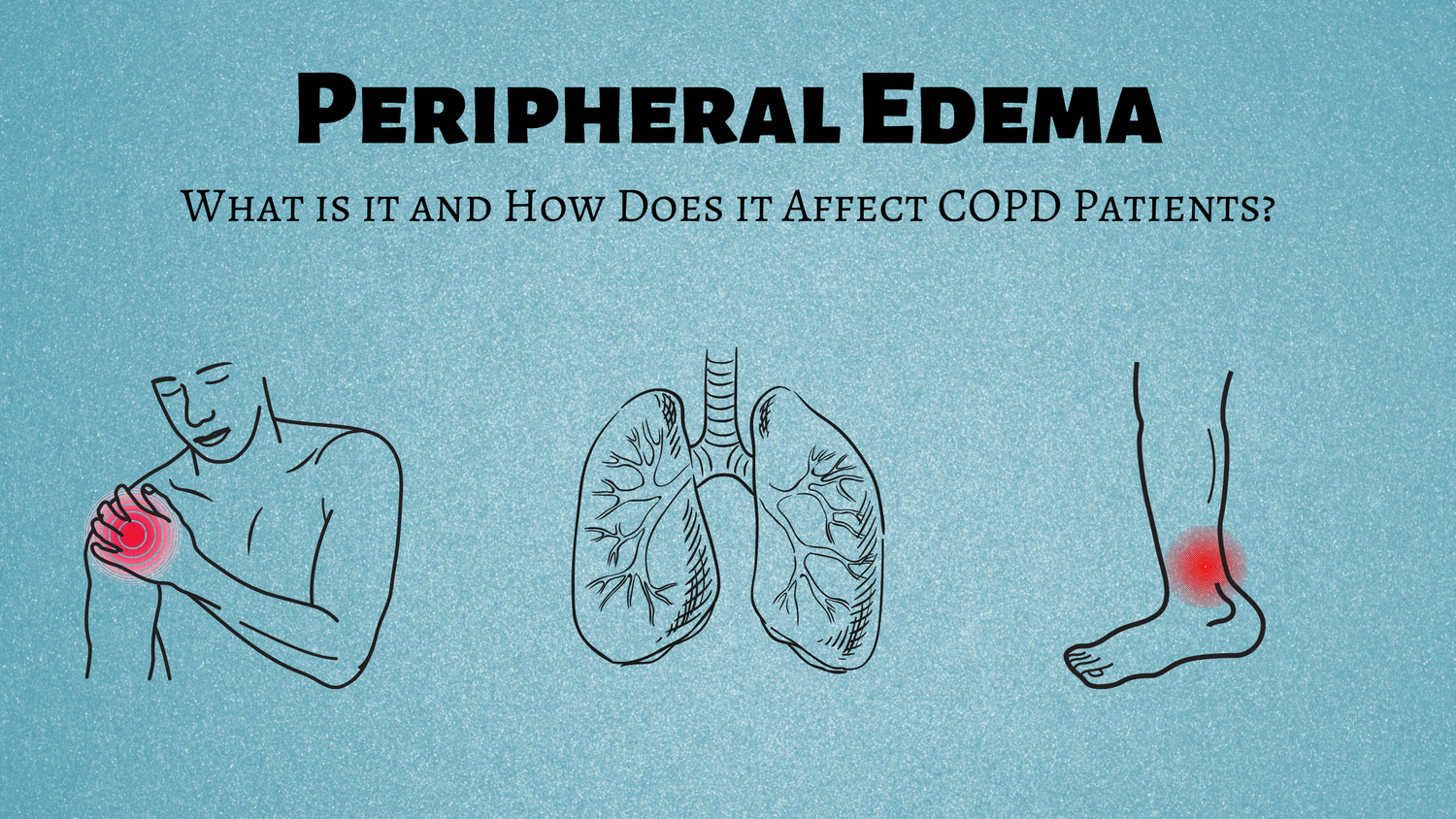 What is Peripheral Edema and Why is it a Concern for COPD Patients?